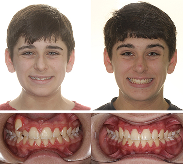 smile results