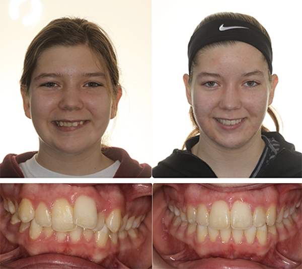 Ashley orthodontics before and after