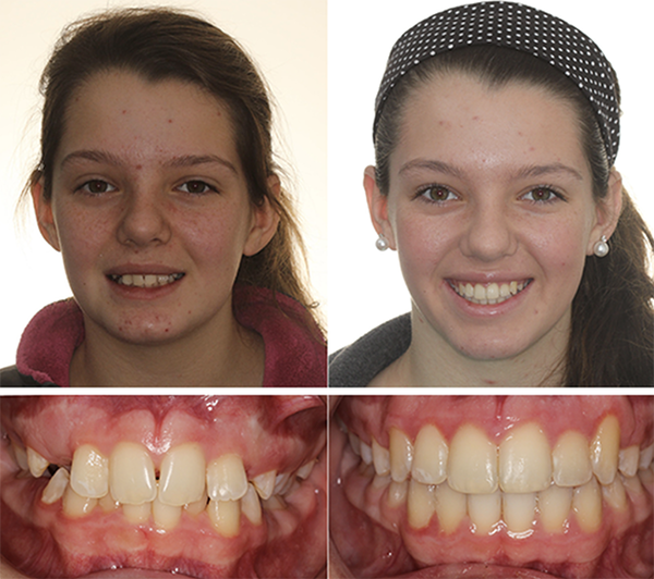 before and after Ashley orthodontics
