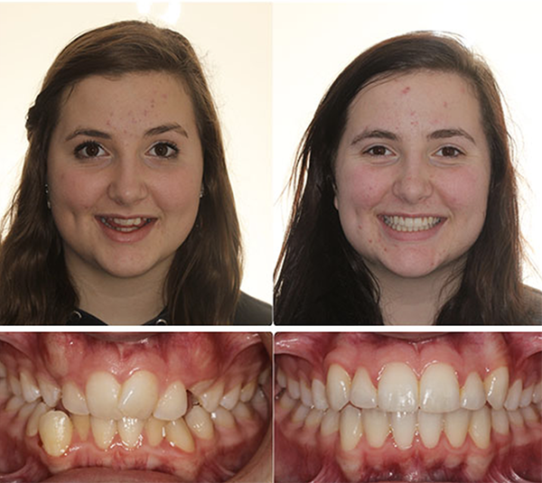 Ashley orthodontics before and after
