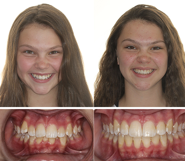 before and after Ashley orthodontics