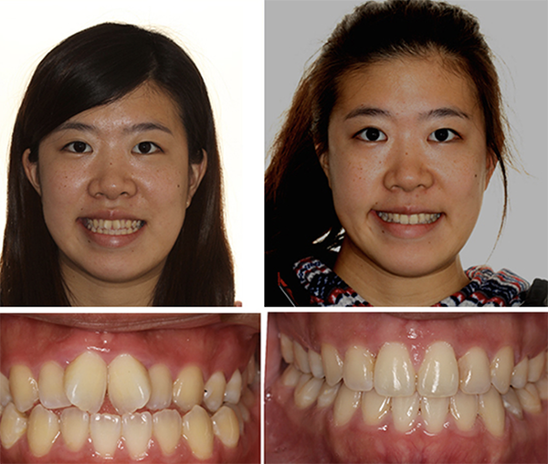 before and after Ashley orthodontics