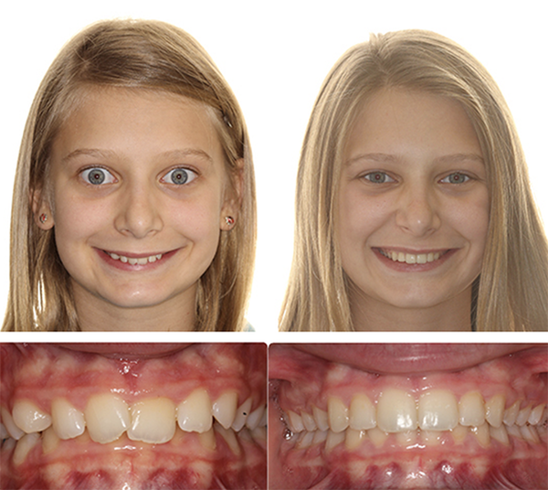 smile results
