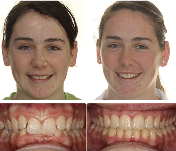 smile results