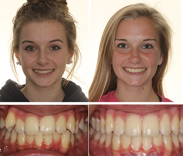 smile results