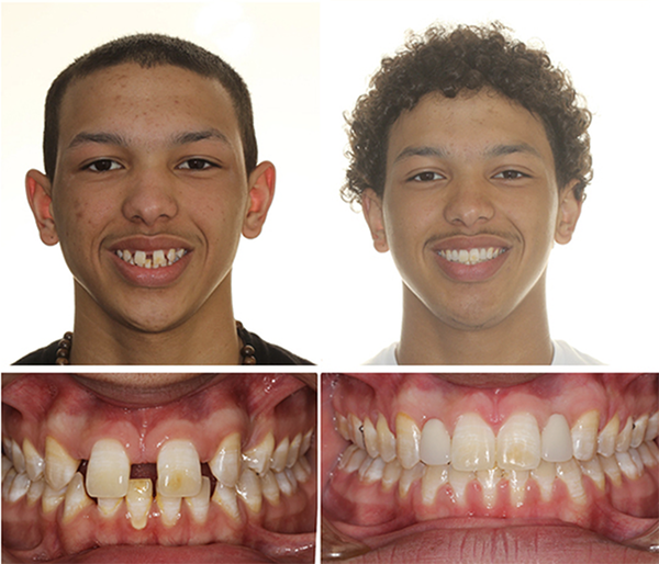 before and after at Ashley orthodontics
