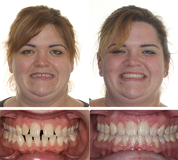 smile results