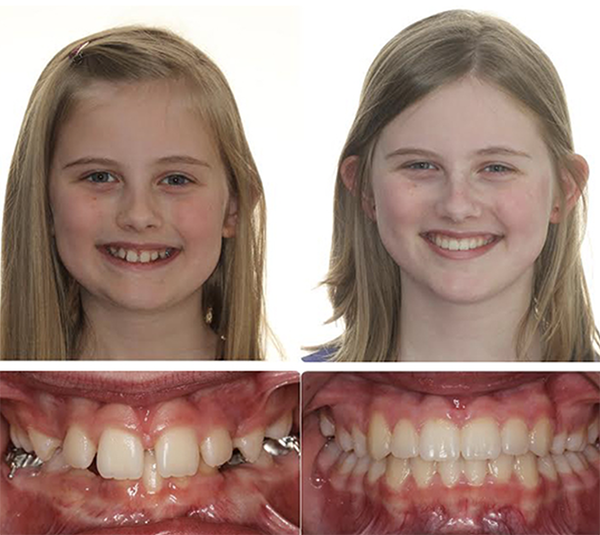 before and after Ashley orthodontics