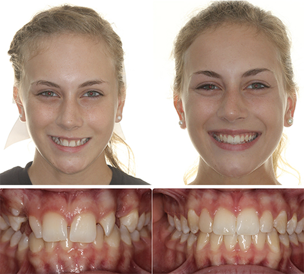 Ashley orthodontics before and after