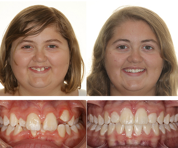 Ashley orthodontics before and after