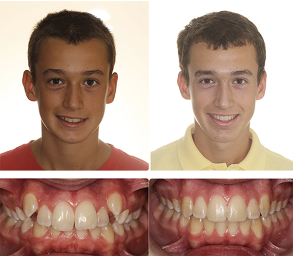 before and after Ashley orthodontics